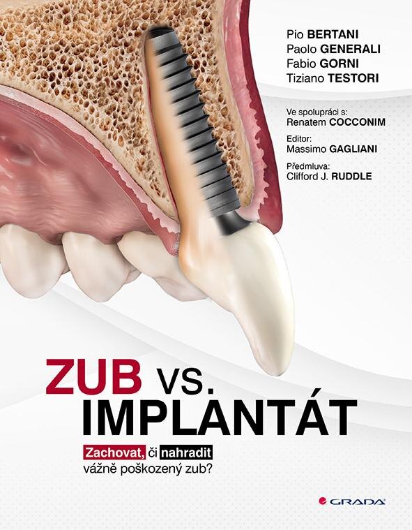 Obálka knihy Zub vs. implantát