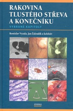 Obálka knihy Rakovina tlustého střeva a konečníku